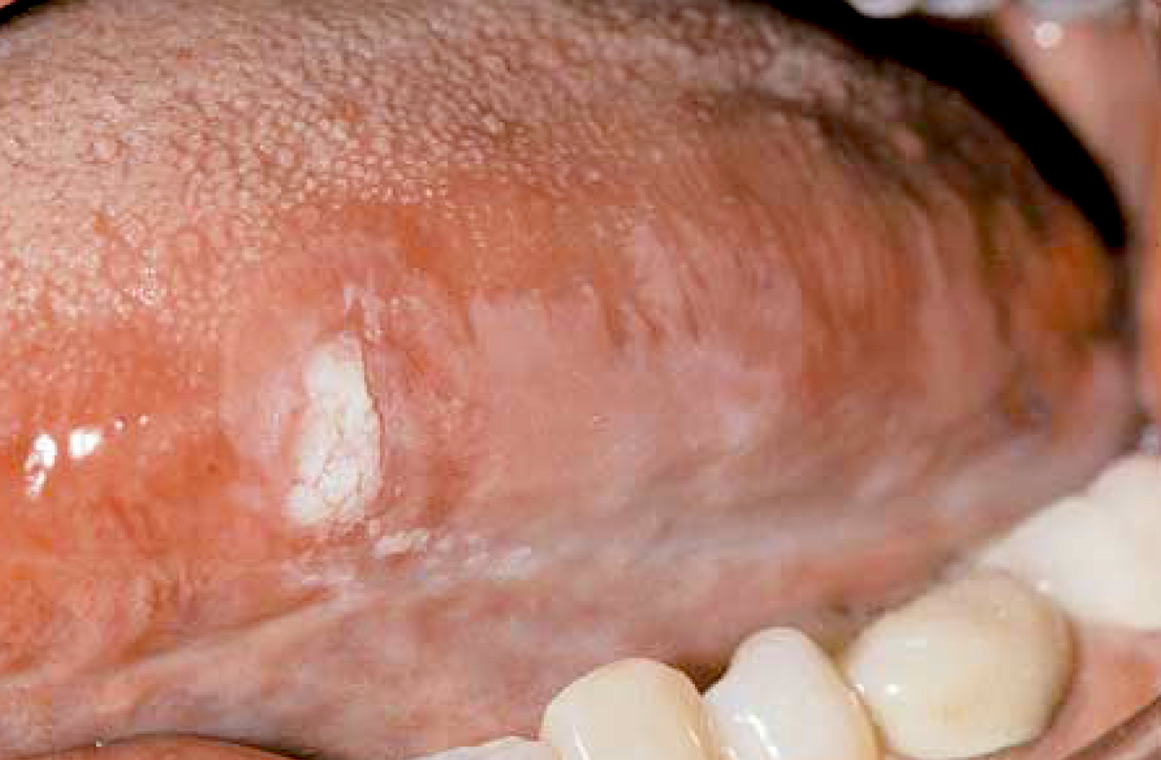 frictional keratosis gums