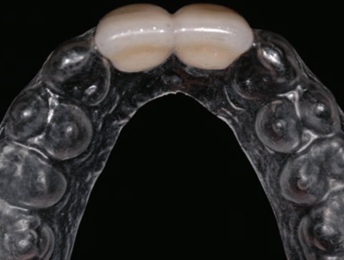 4 provisional prostheses for before and during implant healing